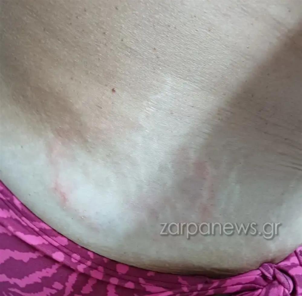 χανια - χελωνα - δαγκωμα χανια - χελωνα - δαγκωμα